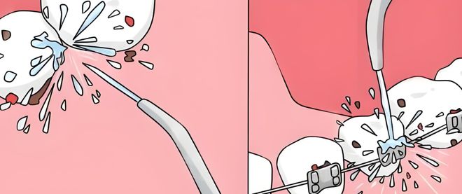水牙线适用人群分析凯发k8国际厅登录(图2)